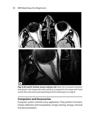 32  MRI Made Easy (For Beginners)
Computers and Accessories
Computer system controls every application. They perform functions
of data collection and manipulation, image viewing, storage, retrieval
and documentation.
A
B
Figs 4.4A and B: Surface versus volume coil. Note the increased resolution
and detail in the image with orbit coil (B) as compared to the image with head
coil (A) Also note decreased signal beyond the orbital apex in image B
Ch-4.indd 32 13-09-2012 15:56:02
 