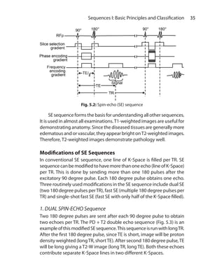 35 Sequences I: Basic Principles and Classification
	 SE sequence forms the basis for understanding all other sequences.
It is used in almost all examinations.T1-weighted images are useful for
demonstrating anatomy. Since the diseased tissues are generally more
edematous and or vascular, they appear bright onT2-weighted images.
Therefore, T2-weighted images demonstrate pathology well.
Modifications of SE Sequences
In conventional SE sequence, one line of K-Space is filled per TR. SE
sequence can be modified to have more than one echo (line of K-Space)
per TR. This is done by sending more than one 180 pulses after the
excitatory 90 degree pulse. Each 180 degree pulse obtains one echo.
Three routinely used modifications in the SE sequence include dual SE
(two 180 degree pulses perTR), fast SE (multiple 180 degree pulses per
TR) and single-shot fast SE (fast SE with only half of the K-Space filled).
1. DUAL SPIN-ECHO Sequence
Two 180 degree pulses are sent after each 90 degree pulse to obtain
two echoes per TR. The PD + T2 double echo sequence (Fig. 5.3) is an
exampleofthismodifiedSEsequence.ThissequenceisrunwithlongTR.
After the first 180 degree pulse, since TE is short, image will be proton
density weighted (longTR, shortTE). After second 180 degree pulse,TE
will be long giving a T2-W image (long TR, long TE). Both these echoes
contribute separate K-Space lines in two different K-Spaces.
Fig. 5.2: Spin-echo (SE) sequence
Ch-5.indd 35 13-09-2012 15:58:19
 