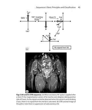 43 Sequences I: Basic Principles and Classification
Figs 5.8A and B: STIR sequence. (A) When excitatory 90° pulse is applied after
a short TI the magnetization vector of fat reaches zero degrees (along positive
side of Z-axis). As the signal cannot be detected when the vector is vertical along
Z-axis, there is no signal from fat and fat is saturated. (B) STIR coronal image of
the pelvis: note there is suppression of subcutaneous fat
B
A
Ch-5.indd 43 13-09-2012 15:58:20
 