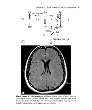 45 Sequences I: Basic Principles and Classification
Figs 5.9A and B: FLAIR sequence. (A) Magnetization vector of water reaches
zero degree when 900
pulse is applied after a longTI. Hence no signal is received
from water and it is nulled. (B) FLAIR axial image of brain: CSF is suppressed and
is dark. Note scalp fat is not suppressed and is bright
B
A
Ch-5.indd 45 13-09-2012 15:58:21
 