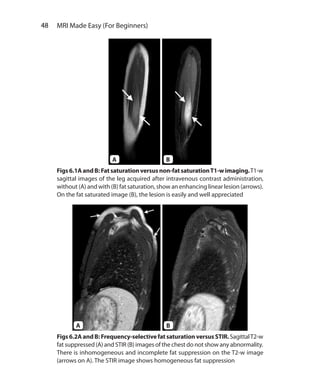 48  MRI Made Easy (For Beginners)
Figs6.1AandB: Fatsaturationversusnon-fatsaturationT1-wimaging.T1-w
sagittal images of the leg acquired after intravenous contrast administration,
without (A) and with (B) fat saturation, show an enhancing linear lesion (arrows).
On the fat saturated image (B), the lesion is easily and well appreciated
Figs6.2AandB: Frequency-selectivefatsaturationversusSTIR.SagittalT2-w
fat suppressed (A) and STIR (B) images of the chest do not show any abnormality.
There is inhomogeneous and incomplete fat suppression on the T2-w image
(arrows on A). The STIR image shows homogeneous fat suppression
A B
A B
Ch-6.indd 48 13-09-2012 15:59:29
 