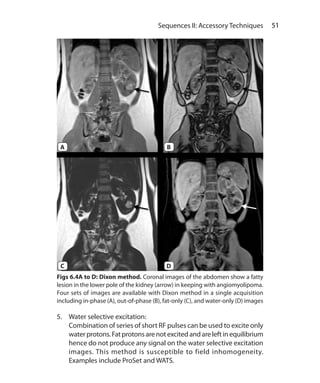 51 Sequences II: Accessory Techniques
5.	 Water selective excitation:
	 Combination of series of short RF pulses can be used to excite only
waterprotons.Fatprotonsarenotexcitedandareleftinequilibrium
hence do not produce any signal on the water selective excitation
images. This method is susceptible to field inhomogeneity.
Examples include ProSet and WATS.
Figs 6.4A to D: Dixon method. Coronal images of the abdomen show a fatty
lesion in the lower pole of the kidney (arrow) in keeping with angiomyolipoma.
Four sets of images are available with Dixon method in a single acquisition
including in-phase (A), out-of-phase (B), fat-only (C), and water-only (D) images
A
C
B
D
Ch-6.indd 51 13-09-2012 15:59:30
 