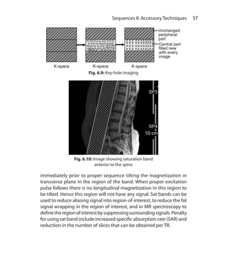 57 Sequences II: Accessory Techniques
immediately prior to proper sequence tilting the magnetization in
transverse plane in the region of the band. When proper excitation
pulse follows there is no longitudinal magnetization in this region to
be tilted. Hence this region will not have any signal. Sat bands can be
used to reduce aliasing signal into region-of-interest, to reduce the fat
signal wrapping in the region of interest, and in MR spectroscopy to
definetheregionofinterestbysuppressingsurroundingsignals.Penalty
for using sat band include increased specific absorption rate (SAR) and
reduction in the number of slices that can be obtained per TR.
Fig. 6.9: Key-hole imaging
Fig. 6.10: Image showing saturation band
anterior to the spine
Ch-6.indd 57 13-09-2012 15:59:30
 