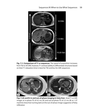 59 Sequences III: When to Use What Sequences
Fig. 7.1: Comparison of T1-w sequences. The speed of acquisition increases
fromTSE to 3D GRE, however,T1 contrast (ability to differentiate structures based
on their T1 relaxation time) is best for TSE and less for GRE sequences
Figs 7.2A and B: In and out-of-phase imaging in fatty liver. Axial T1-w GRE
images at in-phase TE of 4.5 ms (A) and out-of-phase TE of 2.3 ms (B) at 1.5T
machine show liver turning dark on the out-of-phase image suggestive of fatty
infiltration
A B
Ch-7.indd 59 13-09-2012 16:00:32
 