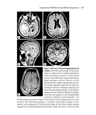 67 Sequences III: When to Use What Sequences
Figs 7.10A to E: Clinical applications of
FLAIR. (A) FLAIR axial image of the brain
shows a large tumor in right hemisphere.
Note the edema anterior to the lesion
(arrow). (B) FLAIR axial image of the brain.
Note multiple chronic infarcts in left
periventricular region indicated by arrows.
(C) FLAIR sagittal image of the brain in
multiple sclerosis. Multiple plaques are
seen running perpendicular to the callosal
margin (arrow) called as ‘Dowson’s fingers’.
Also seen are plaques in the occipital lobe
and the cerebellum (arrowheads). (D)
FLAIR oblique coronal image of the brain shows hippocampi in cross
section. The left hippocampus is atrophic and bright (arrow) in this
patient with epilepsy. (E) FLAIR axial image of the brain. Bright signals
suggestive of subarachnoid hemorrhage (SAH) are seen in cortical sulci
A B
DC
E
Ch-7.indd 67 13-09-2012 16:00:33
 