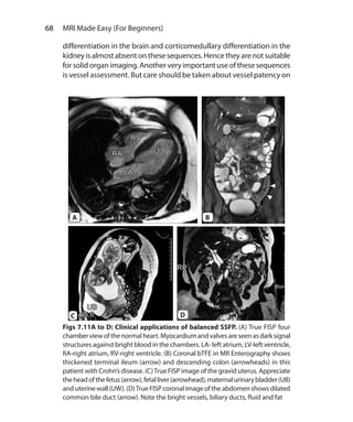 68  MRI Made Easy (For Beginners)
differentiation in the brain and corticomedullary differentiation in the
kidneyisalmostabsentonthese sequences.Hence theyarenotsuitable
for solid organ imaging. Another very important use of these sequences
is vessel assessment. But care should be taken about vessel patency on
Figs 7.11A to D: Clinical applications of balanced SSFP. (A) True FISP four
chamberviewofthenormalheart.Myocardiumandvalvesareseenasdarksignal
structures against bright blood in the chambers. LA- left atrium, LV-left ventricle,
RA-right atrium, RV-right ventricle. (B) Coronal bTFE in MR Enterography shows
thickened terminal ileum (arrow) and descending colon (arrowheads) in this
patient with Crohn’s disease. (C)True FISP image of the gravid uterus. Appreciate
theheadofthefetus(arrow),fetalliver(arrowhead),maternalurinarybladder(UB)
anduterinewall(UW). (D)TrueFISPcoronalimageoftheabdomenshowsdilated
common bile duct (arrow). Note the bright vessels, biliary ducts, fluid and fat
A B
DC
Ch-7.indd 68 13-09-2012 16:00:33
 
