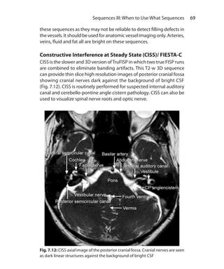 69 Sequences III: When to Use What Sequences
these sequences as they may not be reliable to detect filling defects in
the vessels. It should be used for anatomic vessel imaging only. Arteries,
veins, fluid and fat all are bright on these sequences.
Constructive Interference at Steady State (CISS)/ FIESTA-C
CISS is the slower and 3D version ofTruFISP in which two true FISP runs
are combined to eliminate banding artifacts. This T2-w 3D sequence
can provide thin slice high resolution images of posterior cranial fossa
showing cranial nerves dark against the background of bright CSF
(Fig. 7.12). CISS is routinely performed for suspected internal auditory
canal and cerebello-pontine angle cistern pathology. CISS can also be
used to visualize spinal nerve roots and optic nerve.
Fig. 7.12: CISS axial image of the posterior cranial fossa. Cranial nerves are seen
as dark linear structures against the background of bright CSF
Ch-7.indd 69 13-09-2012 16:00:33
 