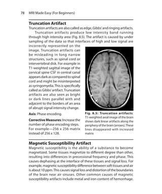 78  MRI Made Easy (For Beginners)
Truncation Artifact
Truncation artifacts are also called as edge, Gibbs’and ringing artifacts.
	 Truncation artifacts produce low intensity band running
through high intensity area (Fig. 8.5). The artifact is caused by under
sampling of the data so that interfaces of high and low signal are
incorrectly represented on the
image. Truncation artifacts can
be misleading in long narrow
structures, such as spinal cord or
intervertebral disk. For example in
T1-weighted sagittal image of the
cervical spine CSF in central canal
appears darkascomparedtospinal
cord and might be misinterpreted
as syringomyelia.This is specifically
called as Gibbs’artifact.Truncation
artifacts are also seen as bright
or dark lines parallel with and
adjacent to the borders of an area
of abrupt signal intensity change.
Axis: Phase encoding.
CorrectiveMeasures: Increase the
number of phase encoding steps.
For example—256 x 256 matrix
instead of 256 x 128.
Magnetic Susceptibility Artifact
Magnetic susceptibility is the ability of a substance to become
magnetized. Some tissues magnetize to different degree than other,
resulting into differences in precessional frequency and phase. This
causes dephasing at the interface of these tissues and signal loss. For
example,magneticsusceptibilitydifference betweensofttissuesandair
is about 10 ppm.This causes signal loss and distortion of the boundaries
of the brain near air sinuses. Other common causes of magnetic
susceptibility artifacts include metal and iron content of hemorrhage.
Fig. 8.5: Truncation artifacts:
T1-weighted axial image of the brain
shows dark linear artifacts along the
periphery of the brain (arrows).These
lines disappeared with increased
matrix
Ch-8.indd 78 13-09-2012 16:02:21
 