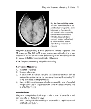 79 Magnetic Resonance Imaging Artifacts
Magnetic susceptibility is more prominent in GRE sequence than
SE sequence (Fig. 8.6). In SE sequences compensation for the phase
differences occurs because there is refocusing of the dephasing caused
by magnetic field inhomogeneities by 180 pulses.
Axis: Frequency encoding and phase encoding.
Corrective Measures
1.	 Use of SE sequence.
2.	 Remove all metals.
3.	 In cases with metallic hardware, susceptibility artifacts can be
reduced to certain extent by increasing bandwidth, reducing TE,
using thin slices and higher matrix.
4.	 Susceptibility artifacts can also be reduced by use of parallel
imaging and use of sequences with radial K-Space sampling like
BLADE/PROPELLER.
Good Effects
Magnetic susceptibility also has good effects apart from artifacts and
can be useful in following ways.
1.	 Used to diagnose hemorrhage, hemosiderin deposition and
calcification (Fig. 8.7).
Fig. 8.6: Susceptibility artifact:
This dark artifact (arrows) in the
axial localizer image of the brain
is because of the magnetic
susceptibility effect caused by
some metallic components
in the bindi (a small sticker
routinely applied on forehead
by Indian women). Similar
artifacts may be caused by
mascara
Ch-8.indd 79 13-09-2012 16:02:22
 