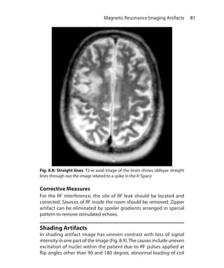 81 Magnetic Resonance Imaging Artifacts
Corrective Measures
For the RF interference, the site of RF leak should be located and
corrected. Sources of RF inside the room should be removed. Zipper
artifact can be eliminated by spoiler gradients arranged in special
pattern to remove stimulated echoes.
Shading Artifacts
In shading artifact image has uneven contrast with loss of signal
intensity in one part of the image (Fig. 8.9).The causes include uneven
excitation of nuclei within the patient due to RF pulses applied at
flip angles other than 90 and 180 degree, abnormal loading of coil
Fig. 8.8: Straight lines: T2-w axial image of the brain shows oblique straight
lines through out the image related to a spike in the K-Space
Ch-8.indd 81 13-09-2012 16:02:22
 
