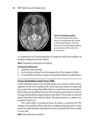 82  MRI Made Easy (For Beginners)
or coupling of coil, inhomogeneity of magnetic field and overflow of
analog-to-digital converter (ADC).
Axis: Frequency and phase encoding.
Corrective Measures
1.	 Load the coil correctly.
2.	 Shimming to reduce the inhomogeneity of the magnetic field.
3.	 To avoid ADC overflow, images are acquired with less amplification.
Cross Excitation and Cross Talk
An RF excitation pulse is not exactly square. As a result, nuclei in slices
adjacent to the one excited by RF pulse may also receive energy and
be excited.This energy flips NMV of these nuclei into transverse plane.
When they are excited by their own RF excitation pulse they do not have
enough longitudinal magnetization to be tilted.This results in reduced
signal intensity in the adjacent slices. This phenomenon is called cross
excitation (Fig. 8.10).
	 The same effect is produced when RF pulse is switched off. The
energy is dissipated to the nuclei from neighbouring slice when nuclei
within the selected slice relax after RF pulse is switched off.This is called
as cross talk.
Axis: Slice selection gradient
Fig. 8.9: Shading artifact:
T2-w axial image of the brain
shows comparatively less signal
in the frontal regions. This was
because of the improper loading
(connection) of the coil in the
anterior part
Ch-8.indd 82 13-09-2012 16:02:22
 