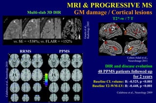 Baseline CL volume: B: -0.525, p <0.001
Baseline T2-WM-LV: B: -0.448, p <0.001
48 PPMS patients followed up
for 2 years
Calabrese et al., Neurology 2009
DIR and disease evolution
MRI & PROGRESSIVE MS
GM damage / Cortical lesionsMulti-slab 3D DIR
Geurtsetal.,
Radiology2005
vs. SE = +538%; vs. FLAIR = +152%
RRMS PPMS
Calabreseetal.,Neurology2010
Cohen-Adad et al.,
NeuroImage 2011
T2*-w / 7 T
 