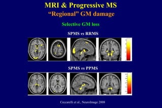 MRI & Progressive MS
“Regional” GM damage
SPMS vs RRMS
SPMS vs PPMS
Ceccarelli et al., NeuroImage 2008
Selective GM loss
 