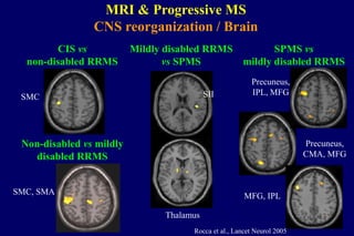 CIS vs
non-disabled RRMS
SMC
Non-disabled vs mildly
disabled RRMS
SMC, SMA
Mildly disabled RRMS
vs SPMS
Thalamus
SII
SPMS vs
mildly disabled RRMS
Precuneus,
IPL, MFG
MFG, IPL
Precuneus,
CMA, MFG
Rocca et al., Lancet Neurol 2005
MRI & Progressive MS
CNS reorganization / Brain
 