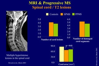 Multiple hyperintense
lesions in the spinal cord
Rovaris et al., Brain 2001
Spinal cord / T2 lesions
MRI & Progressive MS
Number of cord lesions Number of damaged
cord segments
0.0
1.0
2.0
3.0
4.0
5.0
0.0
1.0
2.0
3.0
4.0
5.0
6.0
p = 0.03
0.0
30.0
60.0
90.0
Cord area [mm2]
Rovarisetal.,Brain2001
PPMSSPMSControls
 