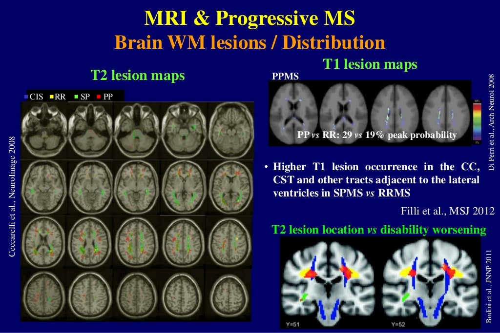 MRI markers to understand progression