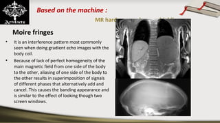 Based on the machine :
MR hardware and room shielding
Moire fringes
• It is an interference pattern most commonly
seen when doing gradient echo images with the
body coil.
• Because of lack of perfect homogeneity of the
main magnetic field from one side of the body
to the other, aliasing of one side of the body to
the other results in superimposition of signals
of different phases that alternatively add and
cancel. This causes the banding appearance and
is similar to the effect of looking though two
screen windows.
 