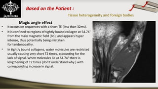 Based on the Patient :
Tissue heterogeneity and foreign bodies
Magic angle effect
• It occurs on sequences with a short TE (less than 32ms). 
• It is confined to regions of tightly bound collagen at 54.74° 
from the main magnetic field (Bo), and appears hyper 
intense, thus potentially being mistaken 
for tendonopathy.
• In tightly bound collagens, water molecules are restricted 
usually causing very short T2 times, accounting for the 
lack of signal. When molecules lie at 54.74° there is 
lengthening of T2 times (don't understand why.) with 
corresponding increase in signal.
Typical sites include :
• proximal part of the posterior 
cruciate ligament (PCL)
• peroneal tendons as they hook 
around the lateral malleolus.
• cartilage can also be affected e.g. 
femoral condyles
• supraspinatus tendon
• triangular fibrocartilage complex (if 
the patient is imaged with the arm 
elevated)
• It appears that at 3.0T the effects 
are reduced.
 