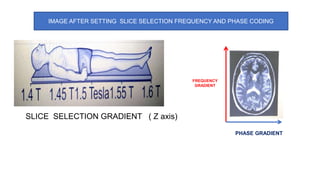 IMAGE AFTER SETTING SLICE SELECTION FREQUENCY AND PHASE CODING
FREQUENCY
GRADIENT
PHASE GRADIENT
SLICE SELECTION GRADIENT ( Z axis)
 