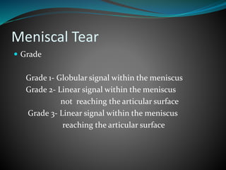 Meniscal Tear
 Grade
Grade 1- Globular signal within the meniscus
Grade 2- Linear signal within the meniscus
not reaching the articular surface
Grade 3- Linear signal within the meniscus
reaching the articular surface
 