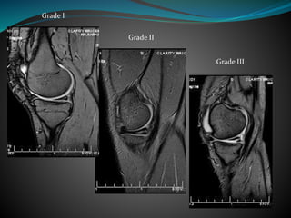 Grade I
Grade II
Grade III
 