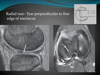 Radial tear- Tear perpendicular to free
edge of meniscus
 