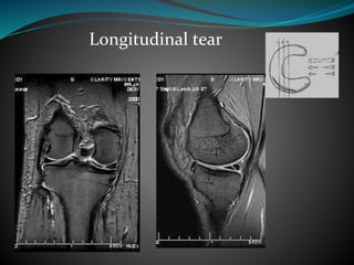 Longitudinal tear
 