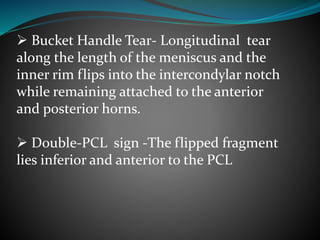  Bucket Handle Tear- Longitudinal tear
along the length of the meniscus and the
inner rim flips into the intercondylar notch
while remaining attached to the anterior
and posterior horns.
 Double-PCL sign -The flipped fragment
lies inferior and anterior to the PCL
 