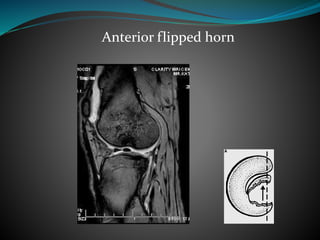 Anterior flipped horn
 