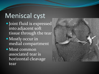 Meniscal cyst
 Joint fluid is expressed
into adjacent soft
tissue through the tear
 Mostly occur in
medial compartment
 Most common
associated tear is
horizontal cleavage
tear
 