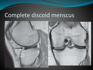 Complete discoid menscus
 