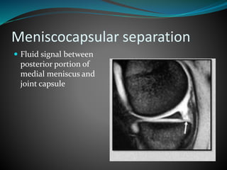 Meniscocapsular separation
 Fluid signal between
posterior portion of
medial meniscus and
joint capsule
 