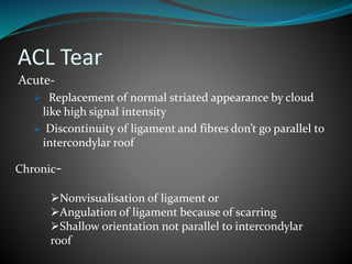 ACL Tear
Acute-
 Replacement of normal striated appearance by cloud
like high signal intensity
 Discontinuity of ligament and fibres don’t go parallel to
intercondylar roof
Chronic-
Nonvisualisation of ligament or
Angulation of ligament because of scarring
Shallow orientation not parallel to intercondylar
roof
 