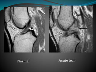 Normal Acute tear
 