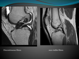 Discontinuous fibres non visible fibres
 
