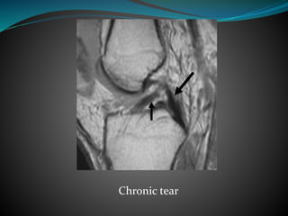 Chronic tear
 