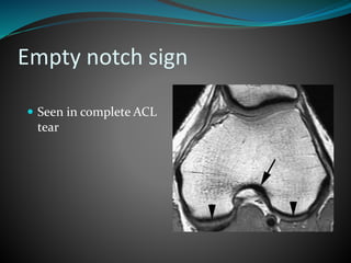 Empty notch sign
 Seen in complete ACL
tear
 