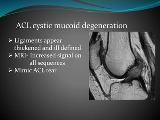 ACL cystic mucoid degeneration
 Ligaments appear
thickened and ill defined
 MRI- Increased signal on
all sequences
 Mimic ACL tear
 