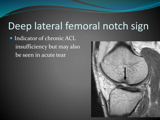 Deep lateral femoral notch sign
 Indicator of chronic ACL
insufficiency but may also
be seen in acute tear
 