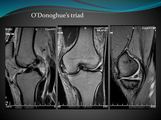 O’Donoghue’s triad
 