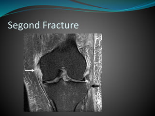 Segond Fracture
 