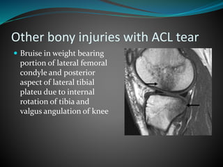 Other bony injuries with ACL tear
 Bruise in weight bearing
portion of lateral femoral
condyle and posterior
aspect of lateral tibial
plateu due to internal
rotation of tibia and
valgus angulation of knee
 