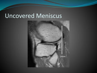 Uncovered Meniscus
7mm
 