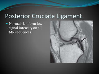 Posterior Cruciate Ligament
 Normal- Uniform low
signal intensity on all
MR sequences
 