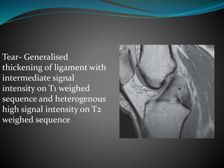 Tear- Generalised
thickening of ligament with
intermediate signal
intensity on T1 weighed
sequence and heterogenous
high signal intensity on T2
weighed sequence
 