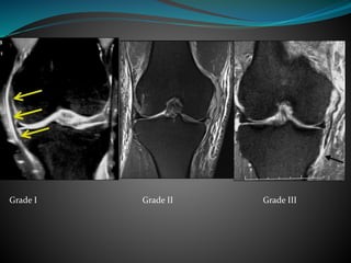 Grade I Grade II Grade III
 