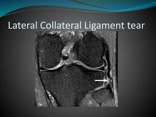 Lateral Collateral Ligament tear
 