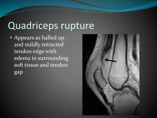 Quadriceps rupture
 Appears as balled up
and mildly retracted
tendon edge with
edema in surrounding
soft tissue and tendon
gap
 