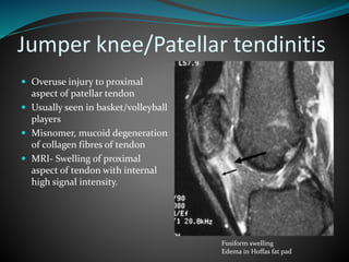 Jumper knee/Patellar tendinitis
 Overuse injury to proximal
aspect of patellar tendon
 Usually seen in basket/volleyball
players
 Misnomer, mucoid degeneration
of collagen fibres of tendon
 MRI- Swelling of proximal
aspect of tendon with internal
high signal intensity.
Fusiform swelling
Edema in Hoffas fat pad
 