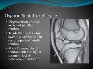 Osgood Schlatter disease
 Degeneration of distal
aspect of patellar
tendon
 Triad- Pain, soft tissue
swelling, ossification in
distal aspect of patellar
tendon
 MRI- Enlarged distal
tendon with low signal
intensity foci of
heterotopic ossification
 